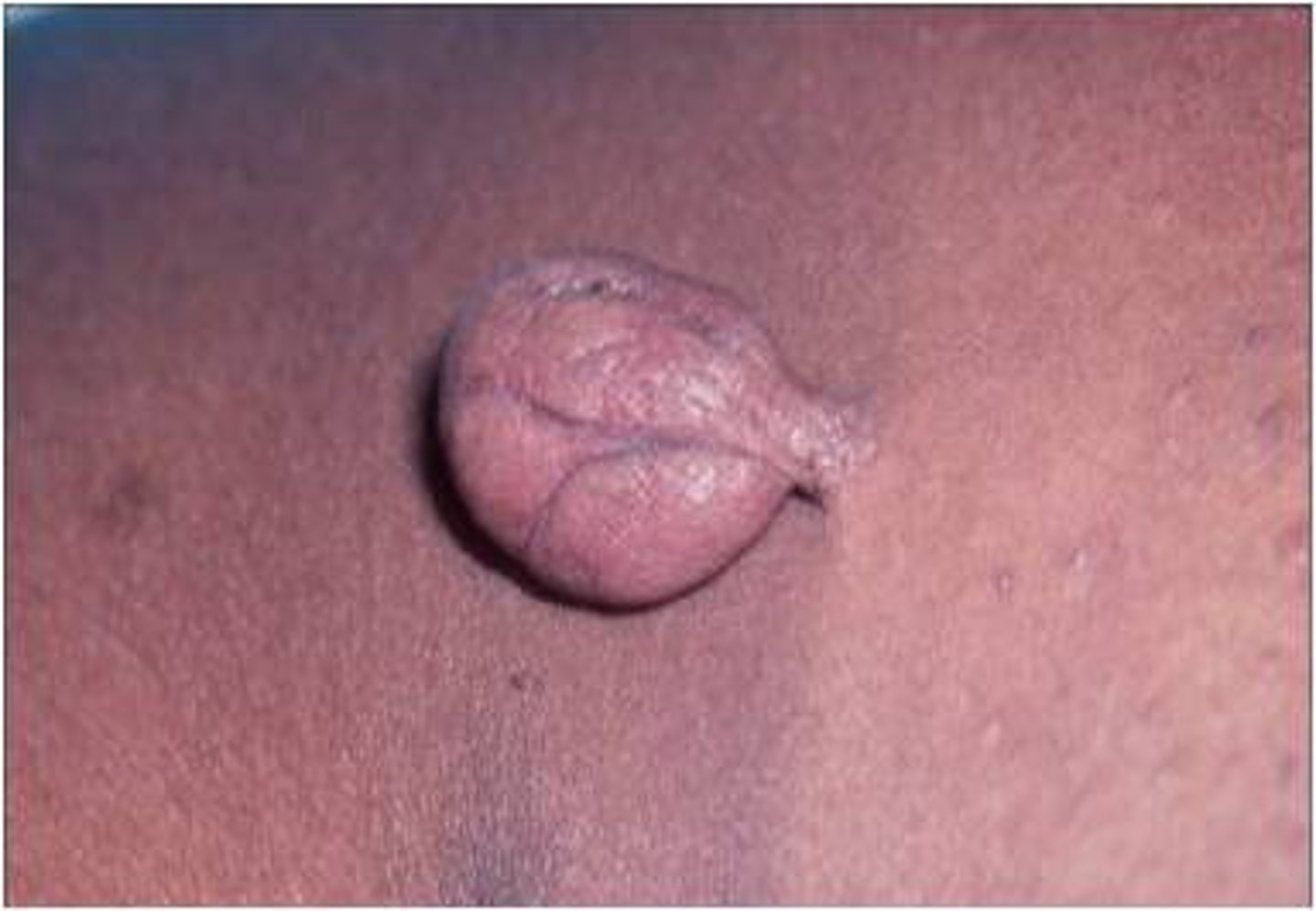 <p>small neck and bigger in middle, like a skin tag</p>