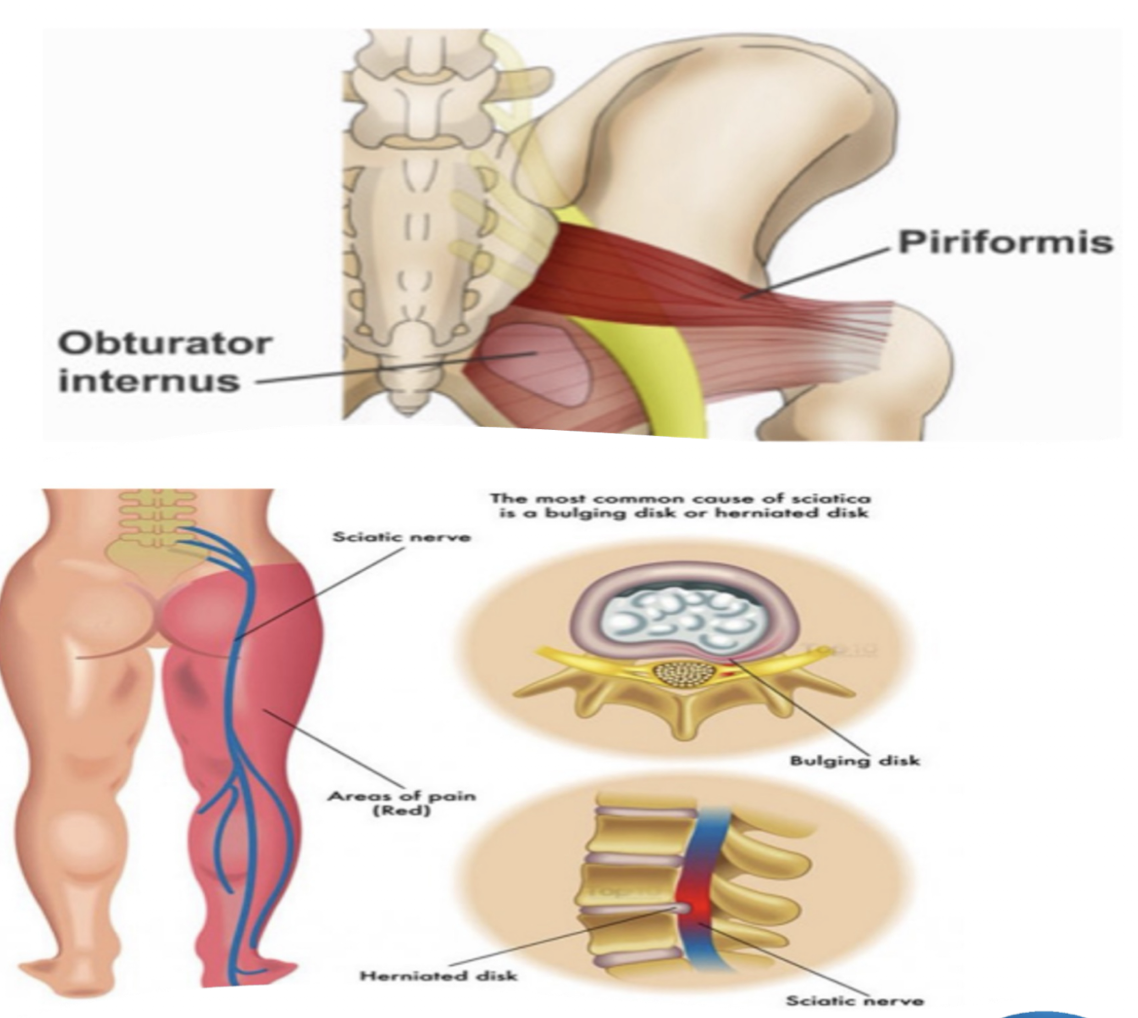 <p>Sciatic Nerve: </p><ul><li><p>Nerve Roots:</p></li><li><p>Originates and Crosses where?</p></li><li><p>Piriformis Syndrome » due to…</p></li></ul><p></p><p></p>