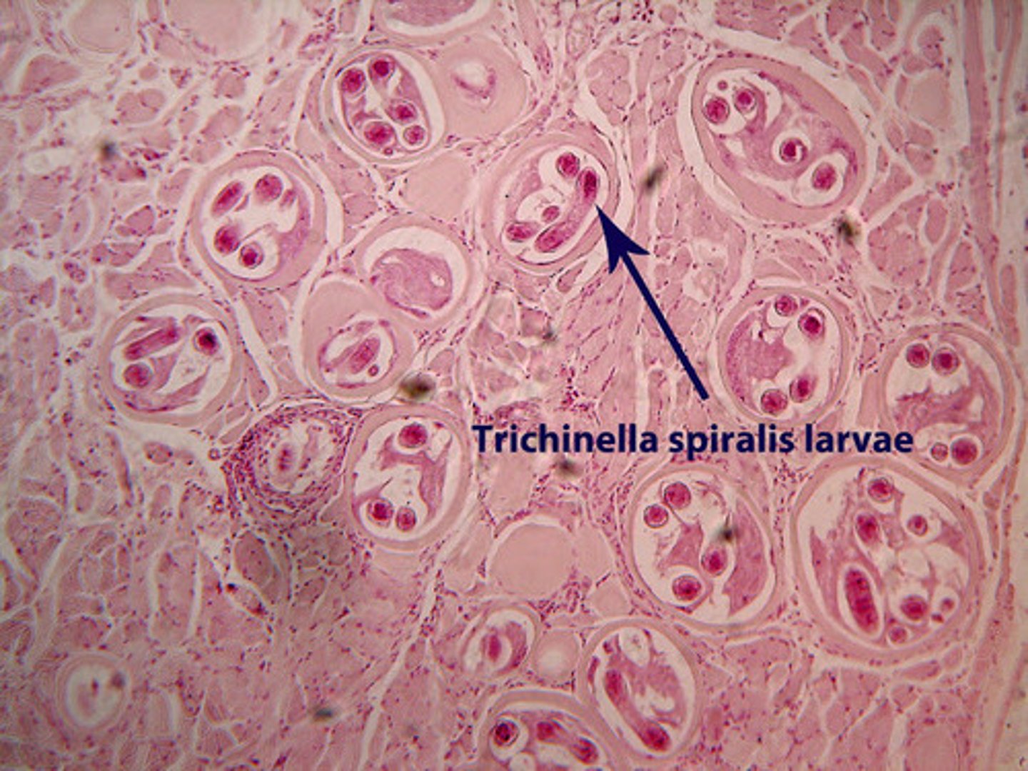 <p>Infection caused by a roundworm; acquired by eating raw or under-cooked meat</p>