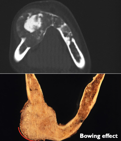 <ul><li><p>Well-defined, unilocular</p></li><li><p>Can be completely radiolucent, or more commonly mixed RL-RO</p></li><li><p>Depends on amount of calcified material</p></li><li><p>Root divergence or resorption of roots can occur</p></li><li><p>Characteristic <strong>downward bowing of the inferior cortex of the mandible </strong></p></li></ul><p></p>