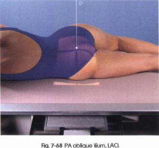 <p><span><strong>PP: </strong>Prone; RAO/LAO; unaffected side elevated 40o (places affected ilium ┴ to IR); patient rested on forearm; knee of elevated side flexed</span></p><p><span><strong>RP: </strong>Level of ASIS</span></p><p><span><strong>CR: </strong>┴</span></p><p><span><strong>SS: </strong>Ilium in profile</span><br><span>• Femoral head within acetabulum</span></p>