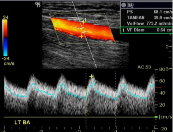 <p>whats the criteria for the volume flow (TAMV) in a fistula</p>