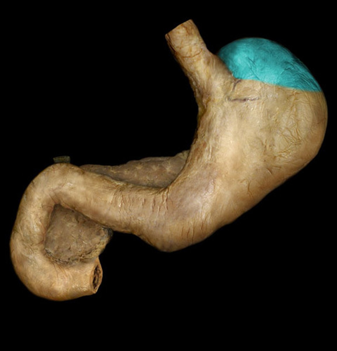 <p>Balloon</p><p>- Top bag-like portion, lateral to the cardia</p>