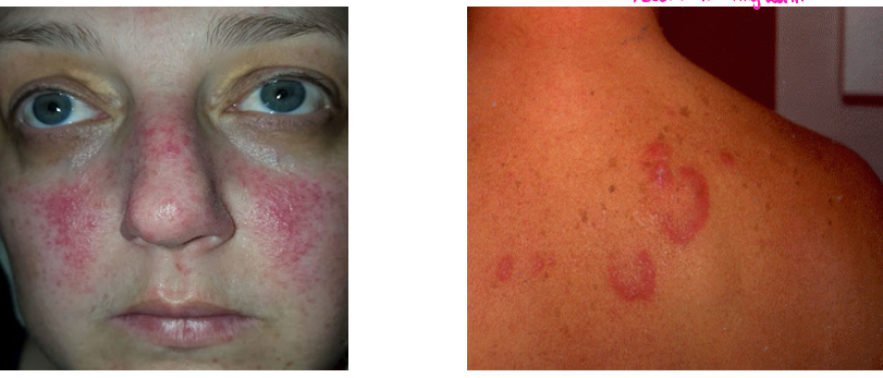 <p><strong>SLE: Clinical Manifestations</strong></p><p><strong>-</strong>Constitutional → _____, fatigue, weight loss </p><p>-MSK → ___-_______ arthritis, arthralgias, myositis </p><p>-Dermatologic → _____ (butterfly) ____, discoid lesions, _____________, oral/nasal ______ (painless), alopecia, urticaria</p>