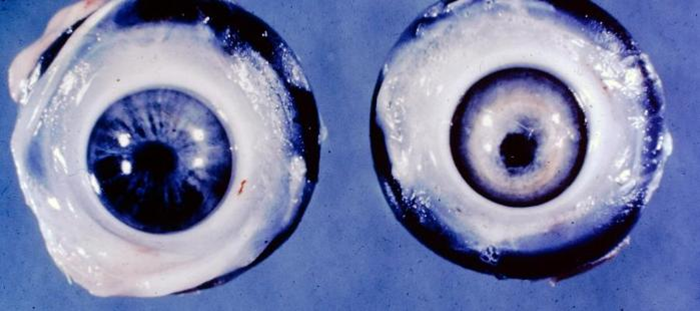 <p>What is the most likely aetiological agent associated with the gross findings?</p>