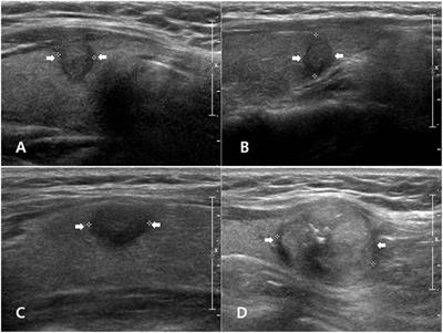 what thyroid pathology is shown here?

palpable, firm, painless, solitary nodule in the thyroid; pt may present with cough, hoarseness, dysphagia, or dyspnea due to compression of adjacent neck anatomy