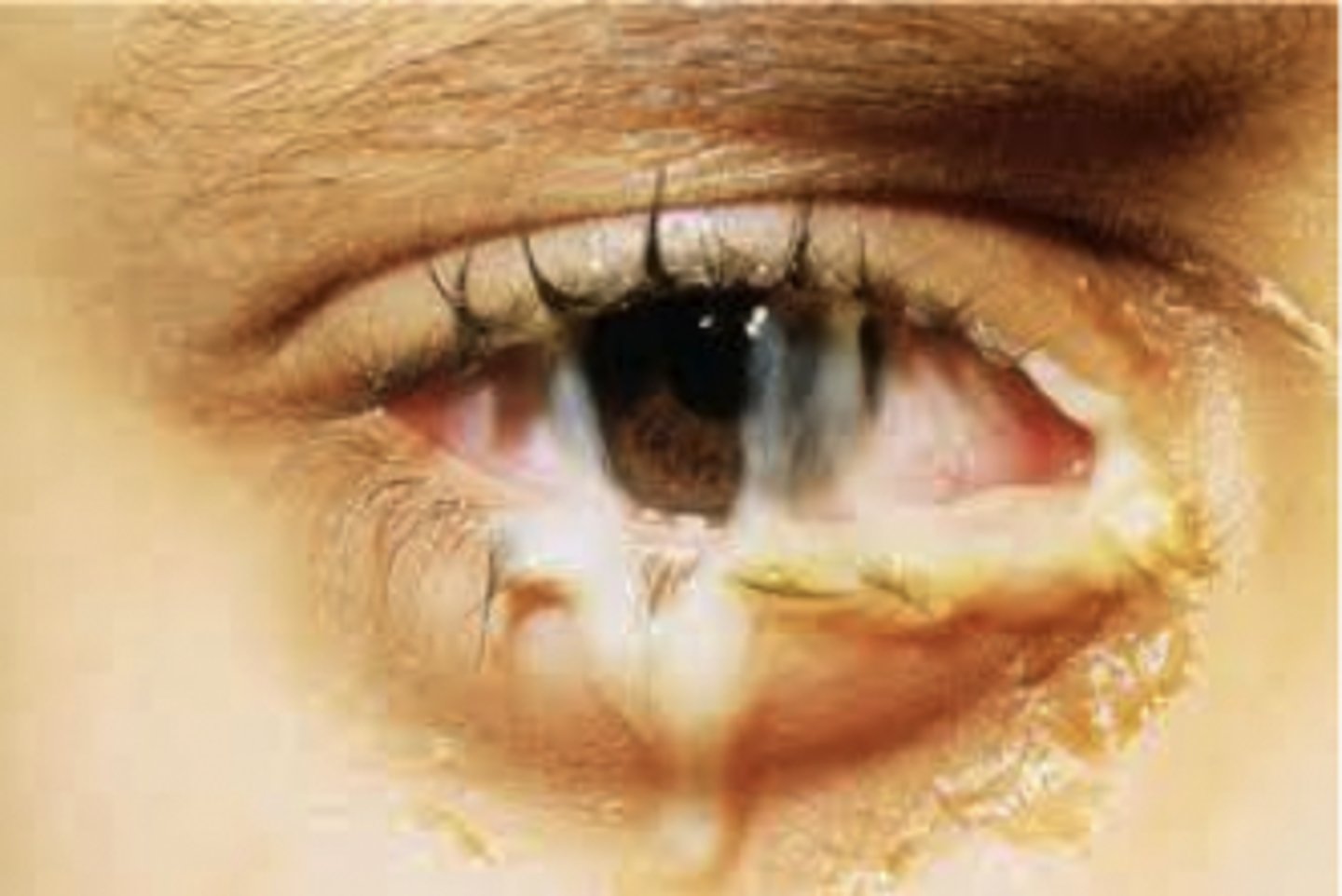 <p><u>Etio:</u> <strong><mark data-color="#faff00" style="background-color: #faff00; color: inherit">Neisseria gonorrhoeae; contagious until cleared x48hrs</mark></strong></p><p><u>S&amp;S:</u> <strong>copious mucopurulent</strong> discharge, sudden onset, FB sensation, no blurring of vision, morning crust, mild discomfort, positive sexual hx of partner with STD/STI</p><p><u>Testing</u>: <strong>STAT gram stain &amp; culture</strong> if + report to PH, offer STI workup/preg test</p><p><u>Tx:</u> <strong><u>NKDA</u></strong>: <strong><mark data-color="#fff100" style="background-color: #fff100; color: inherit">ceftriaxone</mark></strong> 500 mg IM OR Ceftriaxone 1gm IM AND <strong><mark data-color="#f4ff00" style="background-color: #f4ff00; color: inherit">Doxy</mark> </strong>100 mg BID x7 days OR Azithromycin 1 gm PO AND <strong><mark data-color="#faff00" style="background-color: #faff00; color: inherit">Bacitracin</mark></strong> ophthalmic ointment q 3-4 hr x10 days, <strong><u>Penicillin allergy</u></strong>: <strong><mark data-color="#ffeb00" style="background-color: #ffeb00; color: inherit">Azithromycin</mark></strong> 2mg PO AND <strong><mark data-color="#ffe500" style="background-color: #ffe500; color: inherit">Cipro</mark></strong> 500mg PO, referral - ophthalmologist - urgent</p>