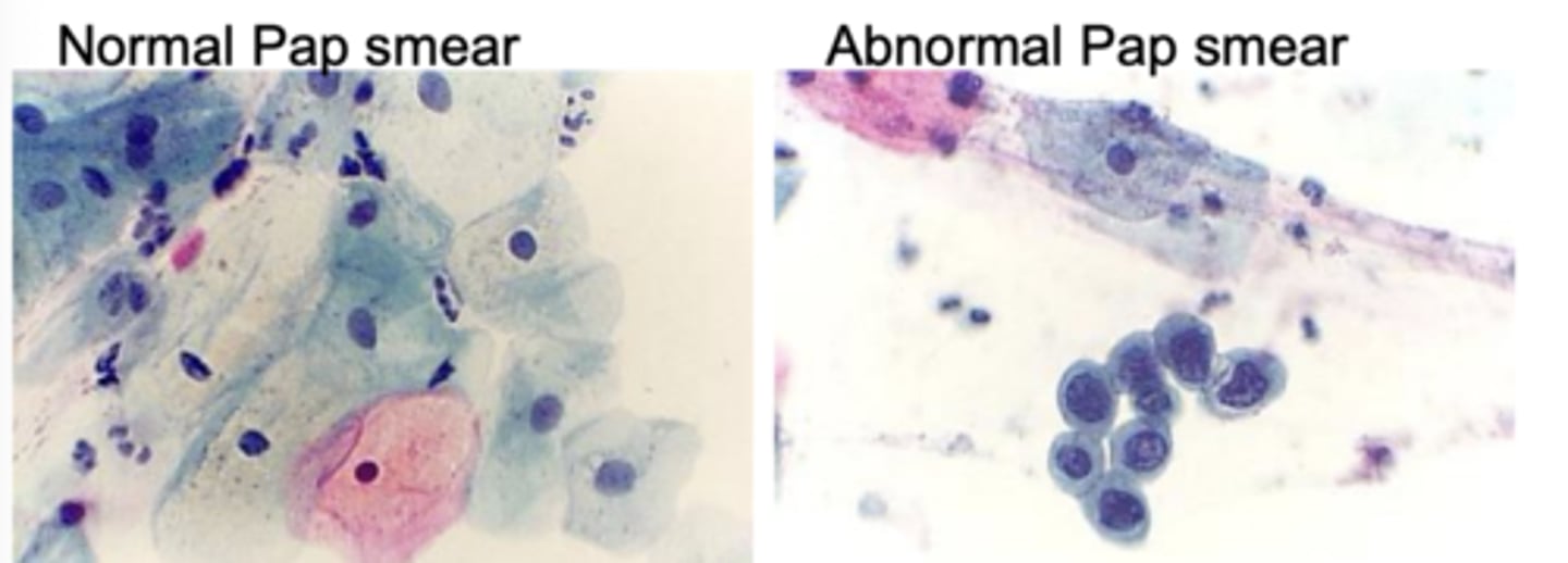 <p>Caused mainly by:</p><p>- 16 18 31</p><p>PCR detection now regularly used in clinic</p><p>Prolonged or persistent HPV infection is comon</p><p>Pap smears can detect early lesion when they are treatable (surgery, cryotherapy)</p><p>Later stage lesion (surgery, radiation, chemotherapy)</p>