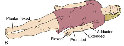 <p>Indicative of a more severe brain injury.</p><p>Opisthotonos (hyperextension of vertebral column) with clenching of teeth, extension, abduction, and hyperpronation of arms with extension of lower extremities.</p>