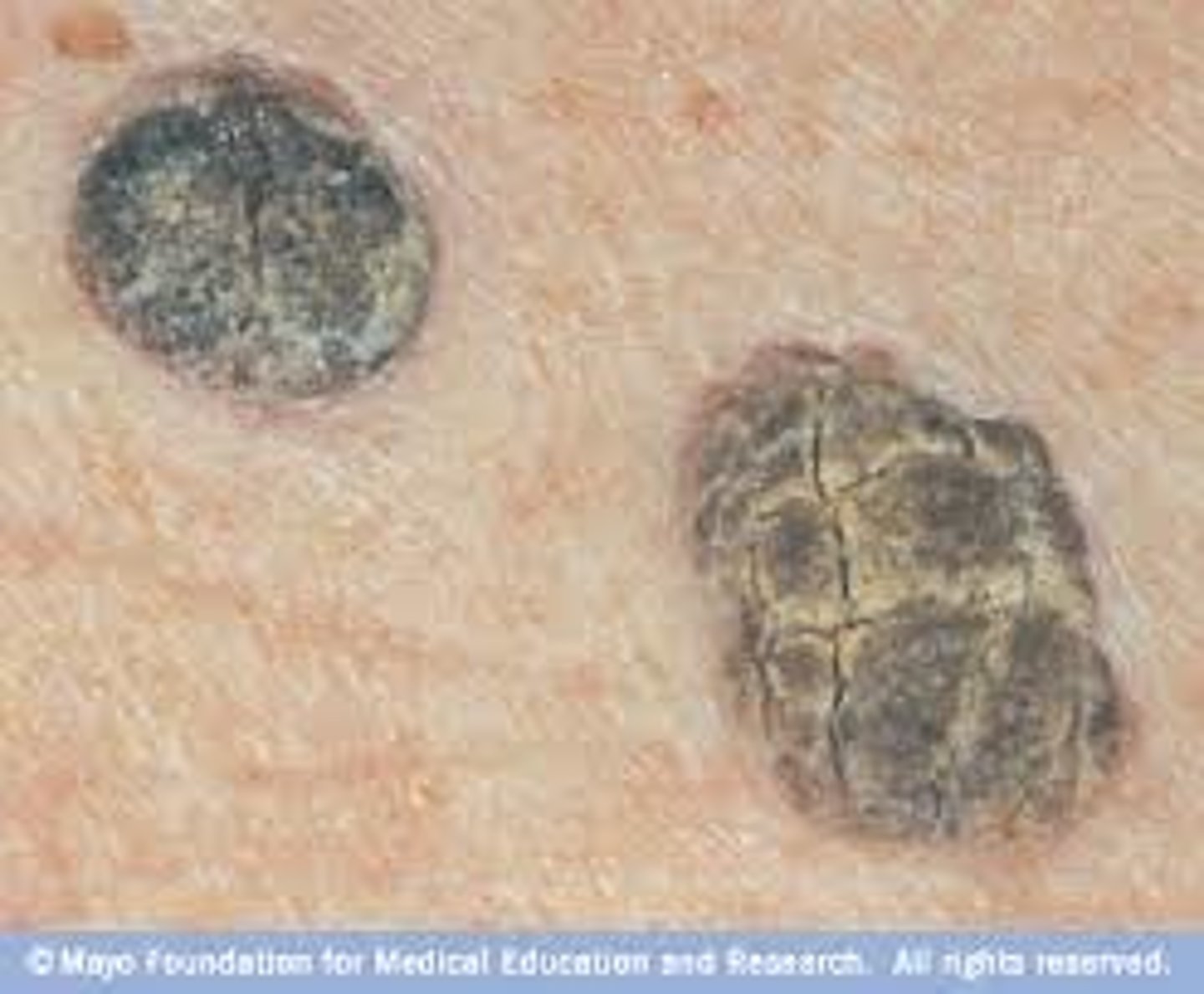 <p>Seborrheic Keratosis</p>