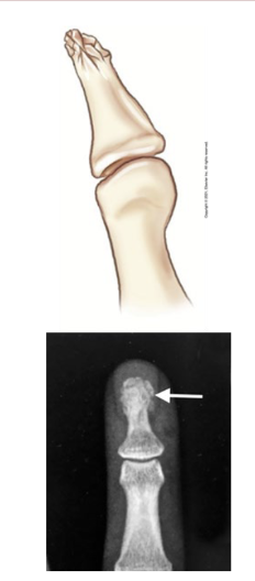 <p>Caused by crushing blow to distal finger or thumb (slamming in a door/hammer)</p>
