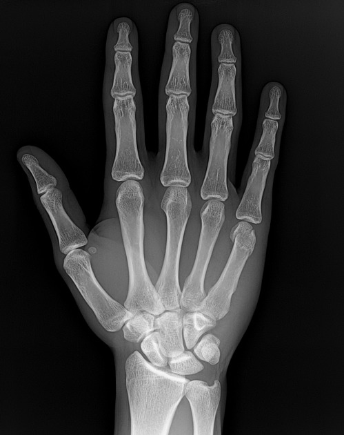 <p>Describe the abnormality demonstrated. </p>