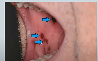 <p><strong>Purpura </strong>– Idiopathic <em>thrombocytopenia </em>purpura and other hematological abnormalities/clotting conditions - bleeding under the surface of the skin </p><p></p>