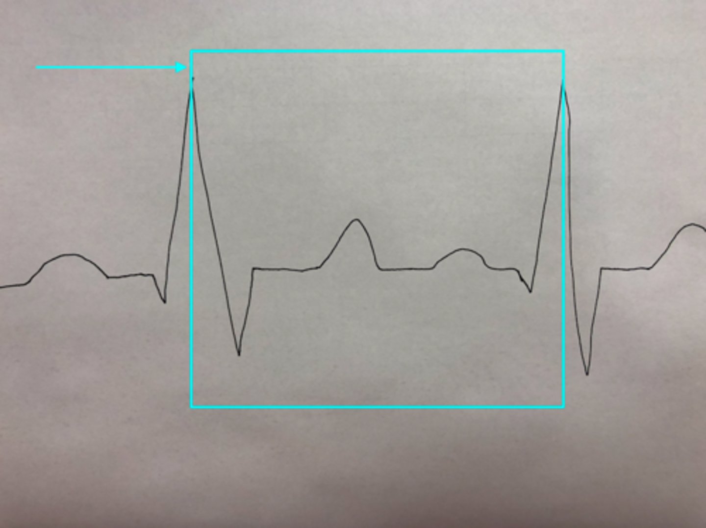 <p>What feature of an ECG is the blue arrow pointing at?</p>