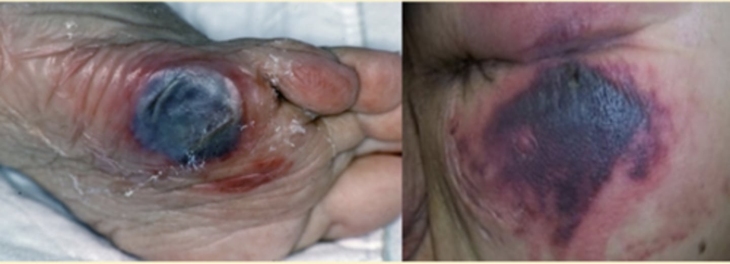 <p>Deep Tissue Pressure Injury</p>