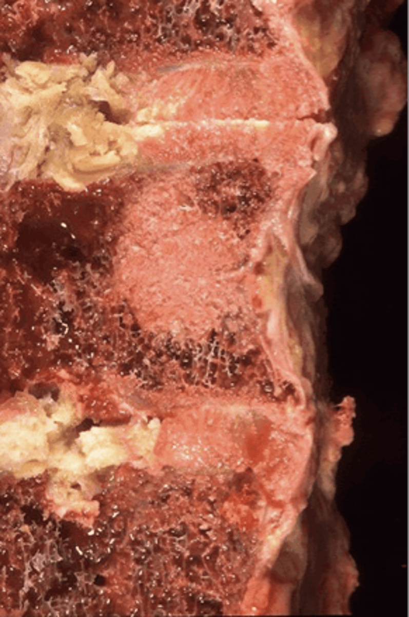 <p>ID skeletal metastasis</p>