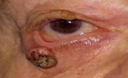 <p>What type of ectropion is caused by mass or edema that physically pulls the lower lid down?</p><ul><li><p>Chalazion, orbital fat, tumor</p></li></ul><p></p>