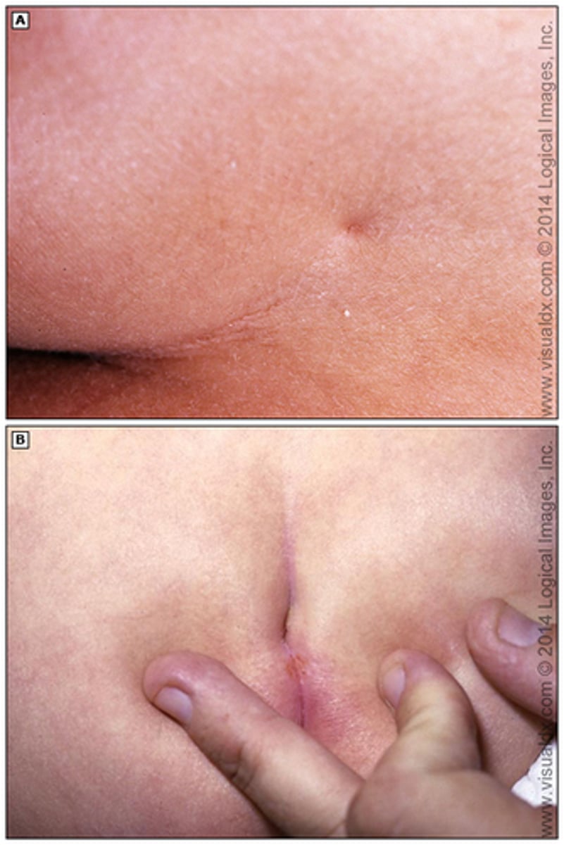 <p>Sacral dimples occur in approximately 5% of neonates and are the most common cutaneous sign of spinal dysraphism (incomplete closure of the neural tube during early embryogenesis, leading to spinal or bony abnormalities). Simple dimples are defined as midline depressions in the dermis that are less than 5 mm in diameter and within 2.5 cm of the anus. Larger lesions ("atypical dimples") and those above the gluteal cleft have been associated with spinal dysraphism. Males and females are equally affected. There are no differences reported among ethnic groups.</p>