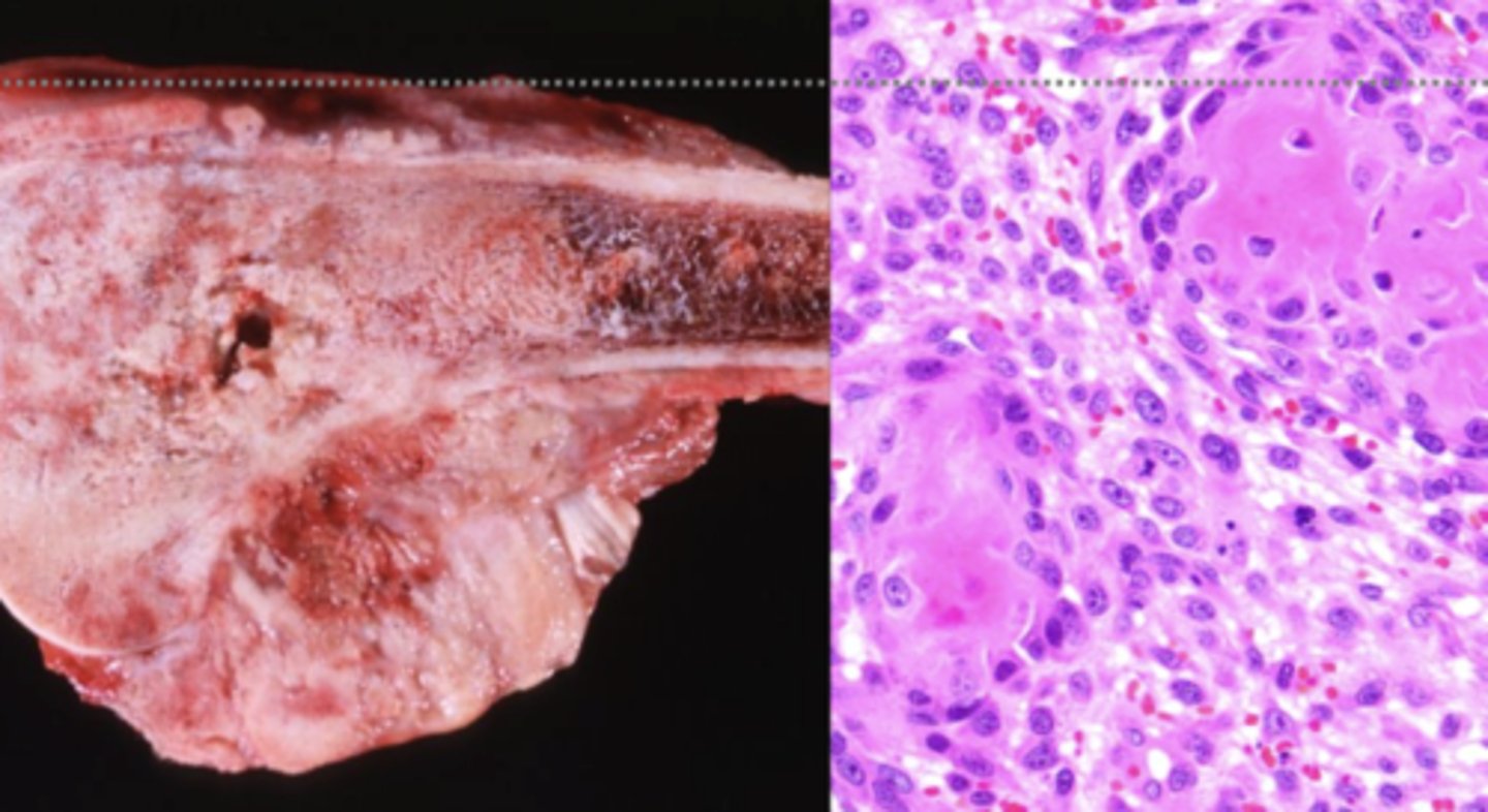 <p>What kind of tumor is this?</p>
