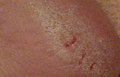 <p>what type of lesion is depicted</p>