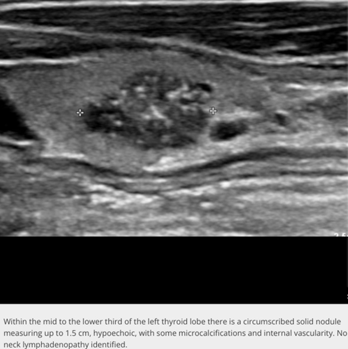 <p>Etiology</p><p>-Papillary (80%)</p><p>-Follicular (5-15%)</p><p>-Medullary (5%)</p><p>-Anaplastic (2%) </p><p>Clinical findings</p><p>-Palpable neck mass</p><p>-Dysphagia</p><p>-Dyspnea</p><p>-Hoarseness</p><p>-Neck pain</p><p>-Lymphadenopathy</p><p>Sonographic findings</p><p>-Hypoechoic mass</p><p>-Irregular borders</p><p>-Thick incomplete peripheral halo</p><p>-Microcalcification(s)</p><p>-May degenerate</p><p>-Increase in size from previous exam</p><p>-Metastases to cervical lymph nodes, lung, bone, and larynx </p>