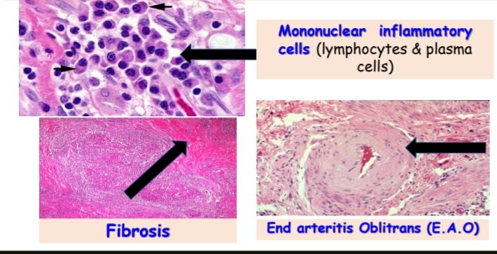 <p>1-Mononuclear inflammatory cells (lymphocytes &amp; plasma cells)</p><p>2-fibrosis</p><p>3-End arteritis Oblitrans (Ε.Α.Ο)</p>