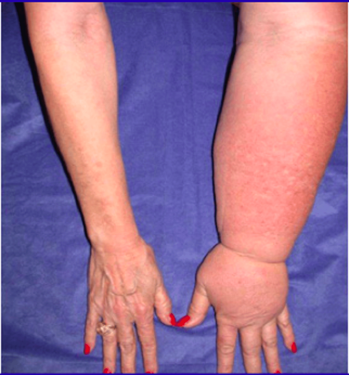 <p>Swelling from lymph buildup; avoid BP or IV in that arm.</p>