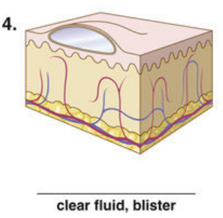 <p><span style="color: red">F Match each of the following lesions with their illustrations in Figure 16-26.</span></p><p></p>