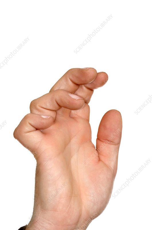 <p>-Loss of intrinsic muscle action and the over-activation of the extrinsic extensor muscles on the proximal phalanx of the fingers</p><p>-MCP joints are hyperextended and PIP/DIP joints are flexed</p><p>-Caused by combination of median and ulnar nerve palsy</p>