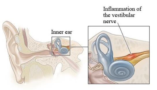 <p>Caused by:</p><ul><li><p>Inflammation of the <strong><u>vestibular nerve</u></strong></p></li></ul><p>Symptoms:</p><ul><li><p>Sudden vertigo that can last for several days</p></li><li><p><u>Does not</u> affect hearing</p></li></ul><p>Treatment:</p><ul><li><p>Anti-nausea medication until inflammation reduces</p></li><li><p>Steroids to reduce inflammation</p></li><li><p>Physical therapy/activity can help the body compensate (help with balance training)</p></li></ul><p></p>