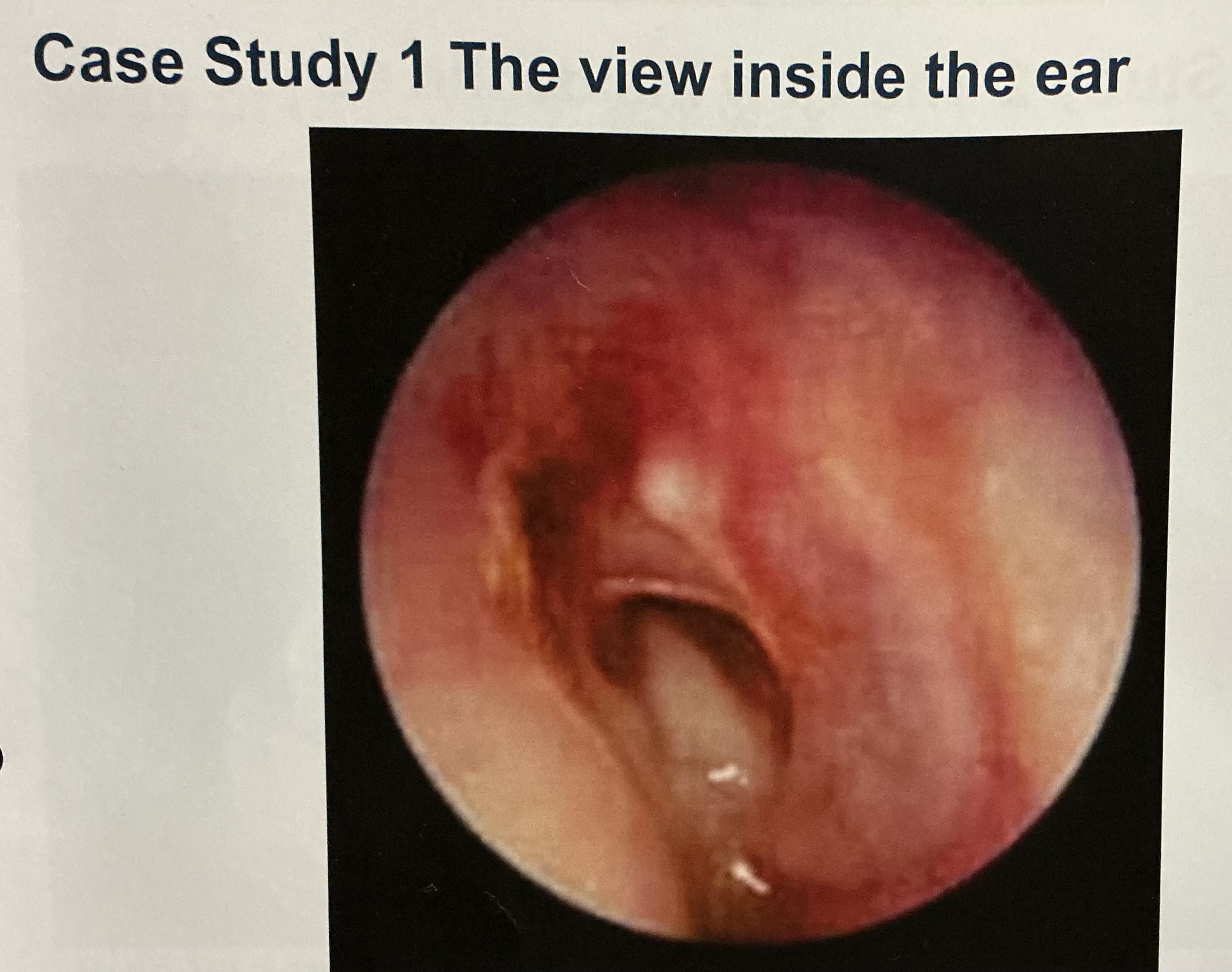 <p><u>Case Study 1</u></p><ul><li><p><span>It is Friday afternoon and Sam Small has asked the pharmacy assistant if he could speak to the pharmacist as they want to ask their advice about their ear. The pharmacy assistant has referred this request to you, as the community pharmacist.</span></p></li></ul><ul><li><p><span>﻿﻿You have asked Sam to come to the pharmacy consultation room. You note they are pressing a tissue to their right ear with their right hand.</span></p></li></ul><p></p>