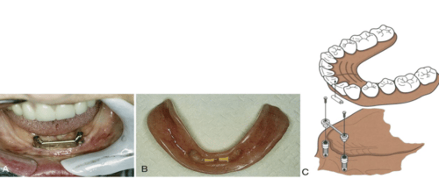 <p>used for dentures, partial snaps on</p><p>lower anteriors</p>