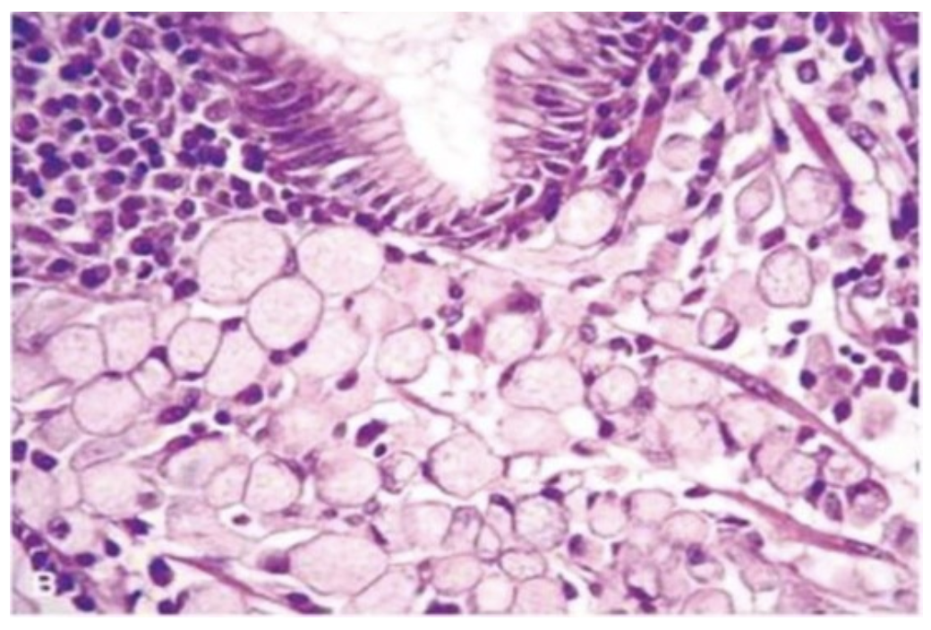 <p>A 42-year-old man presented with a two-month history of abdominal discomfort, anorexia, and weight loss. An upper endoscopic examination showed a 3 × 7 cm ulcerated mass, located 50 cm from the incisors, in the distal gastric antrum. The mass was confirmed on endoscopic ultrasound which also revealed the presence of gastrohepatic lymphadenopathy measuring up to 1.6 cm in maximum diameter. A gastric biopsy was performed, and the microscopic appearance of the biopsy specimen is shown in the attached figure. Molecular studies of tumor cells would most likely reve&nbsp;al abnormalities in which of the following genes encoding?</p><p></p><p>Adenomatous polyposis coli</p><p></p><p>β-catenin</p><p>&nbsp;</p><p>E-cadherin</p><p>&nbsp;</p><p>P16 protein</p><p>&nbsp;</p><p>P53 protein</p>