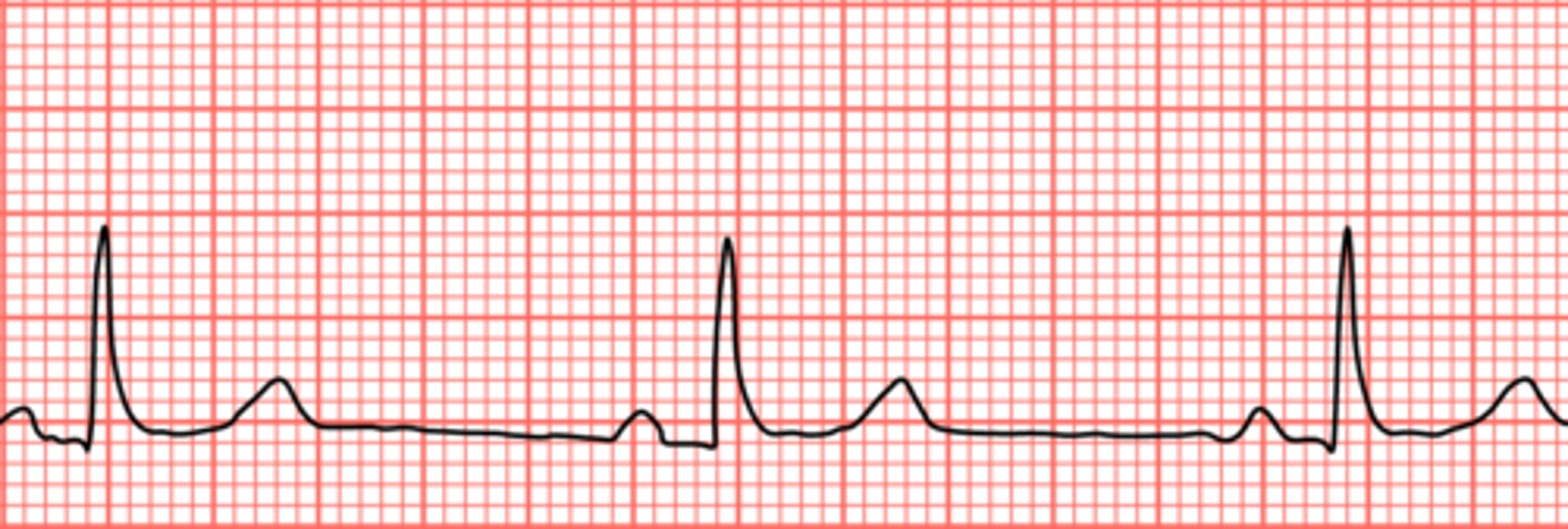 <p>less than 60 bpm.</p>
