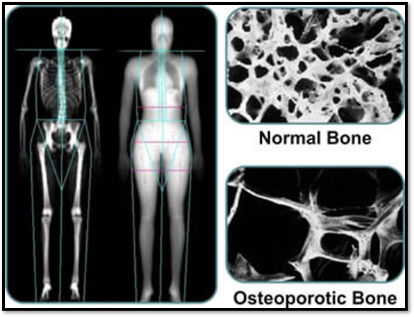 <p>Diagnostic Studies (osteoporosis)  <a target="_blank" rel="noopener noreferrer nofollow" href="https://www.nof.org/patients/diagnosis-information/bone-density-examtesting/"><strong><span>https://www.nof.org/patients/diagnosis-information/bone-density-examtesting</span></strong></a></p>