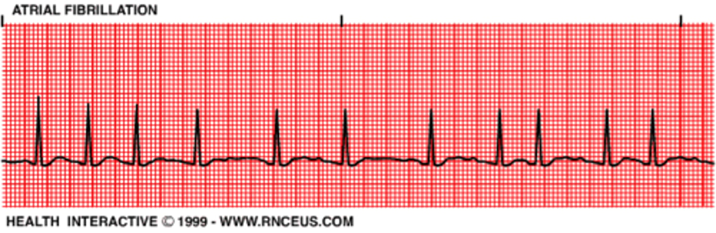 <p>IRREGULAR</p><p>Atrial rate: UNMEASURABLE</p><p>Ventricular rate: variable</p><p>P wave: unable to see</p><p>PR Interval: N/A</p><p>QRS: <0.12 sec</p>