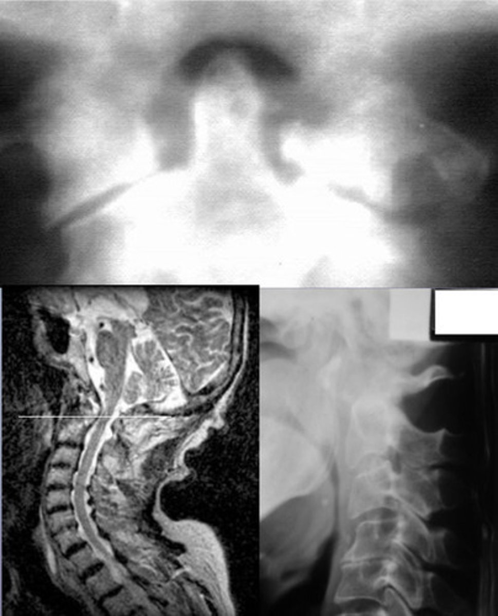 <p>Occ-C1, C1-C2</p><p>facet erosions</p><p>Basilar</p><p>invagination</p><p>Potential</p><p>neurological</p><p>compromise</p><p>These all indicate what?</p>