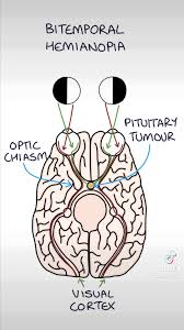 <p>bitemporal hemianopsia</p><ul><li><p><span>loss of vision in the outer temporal (sides) of both eyes</span></p></li></ul><p></p>