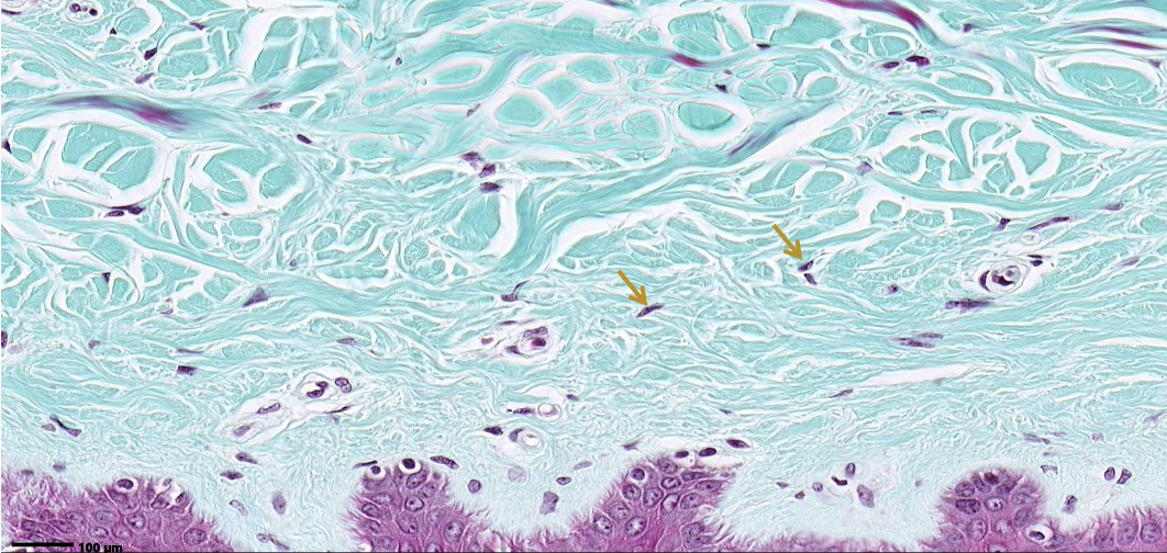 <p>Classify the predominant CT.  ID the cells at the arrows.</p>