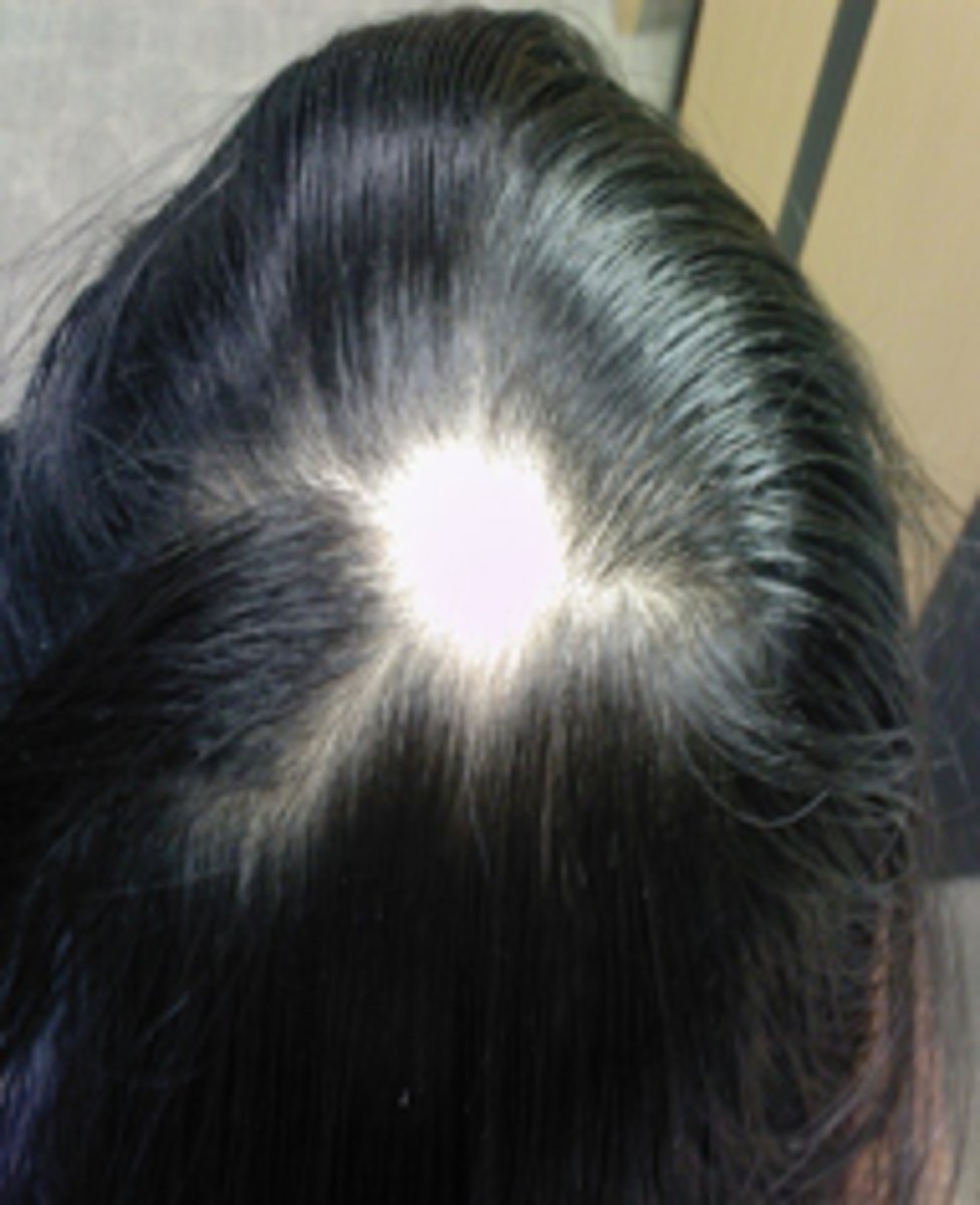 <p>"spot baldness"</p>