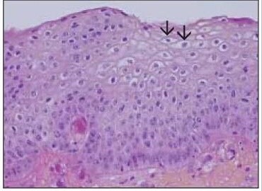 HPV ou Human Papilomavirus