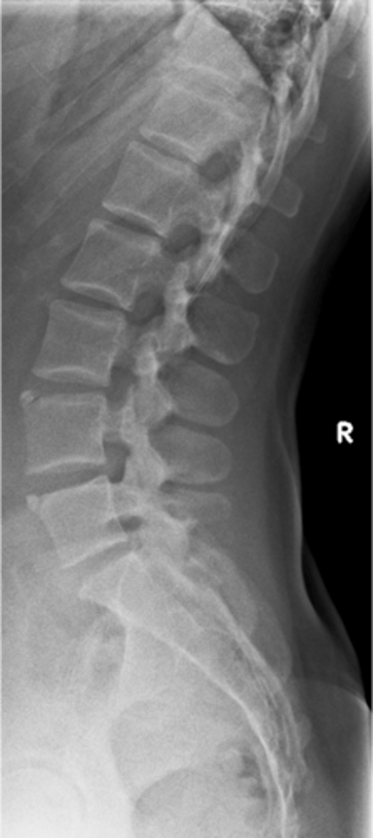<p>A Schmorl's node that cleaves off a peripheral piece of the vertebral body</p>