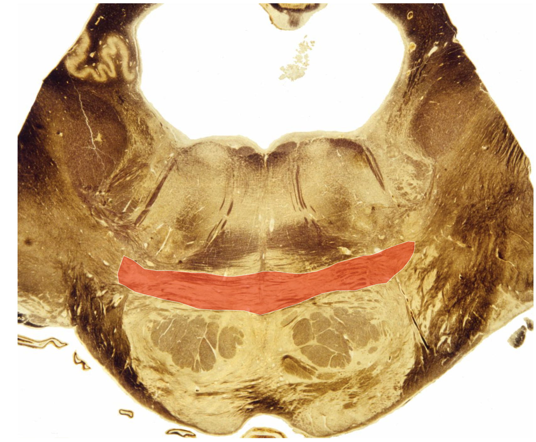 <p>Pontocerebellar Tract - </p>