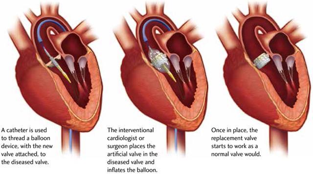 <p>Transcatheter aortic valve replacement (TAVR)</p>
