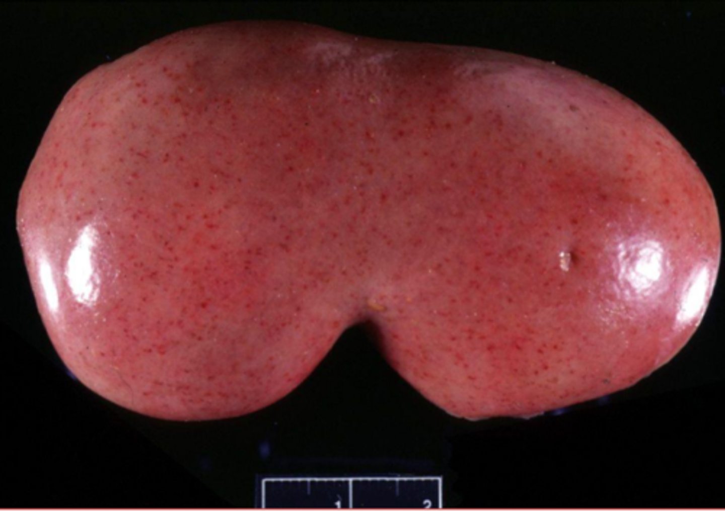 <p>what type of blood spot on this kidney?</p>
