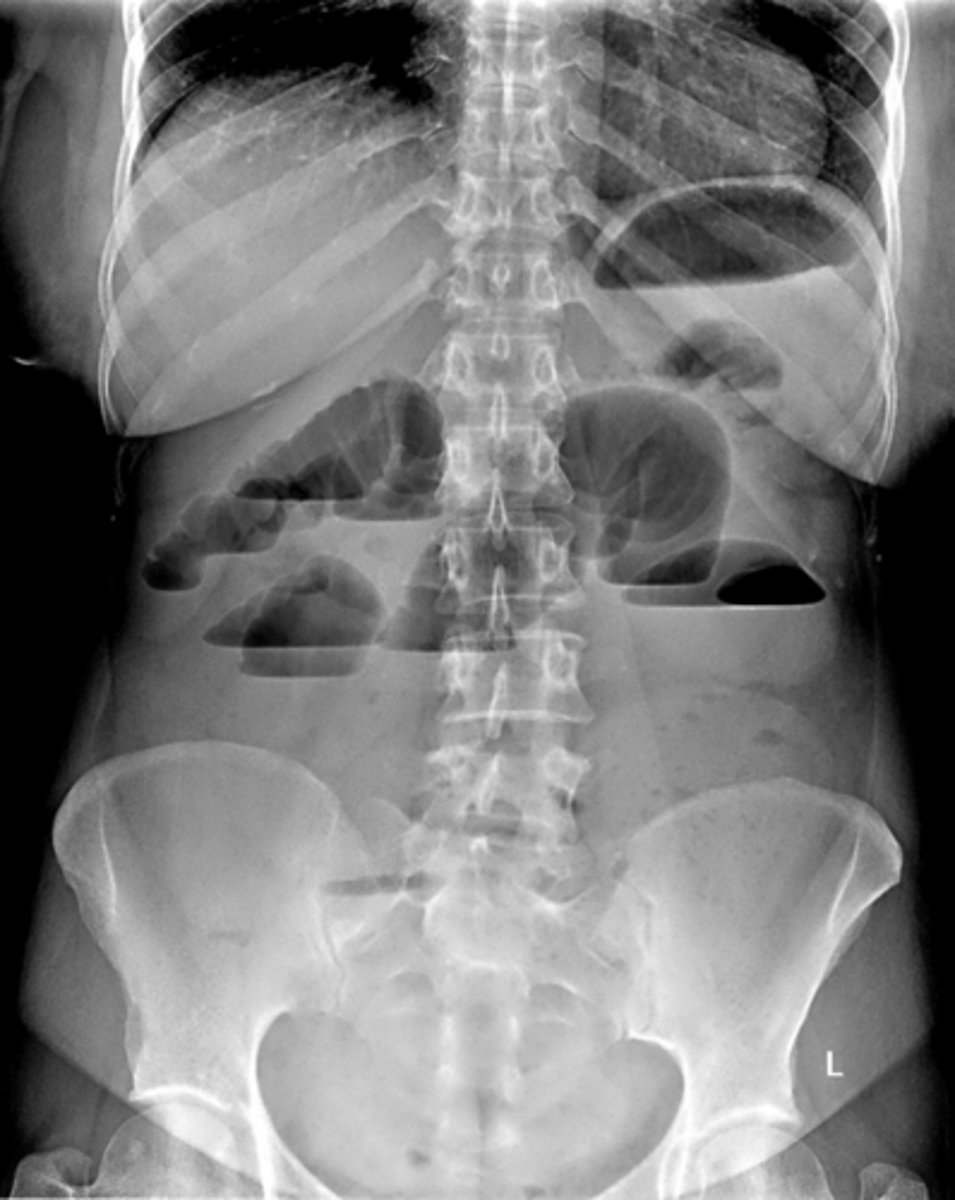 <p>caused by mechanical obstruction or impaired bowel motility, looks like a slinky</p>