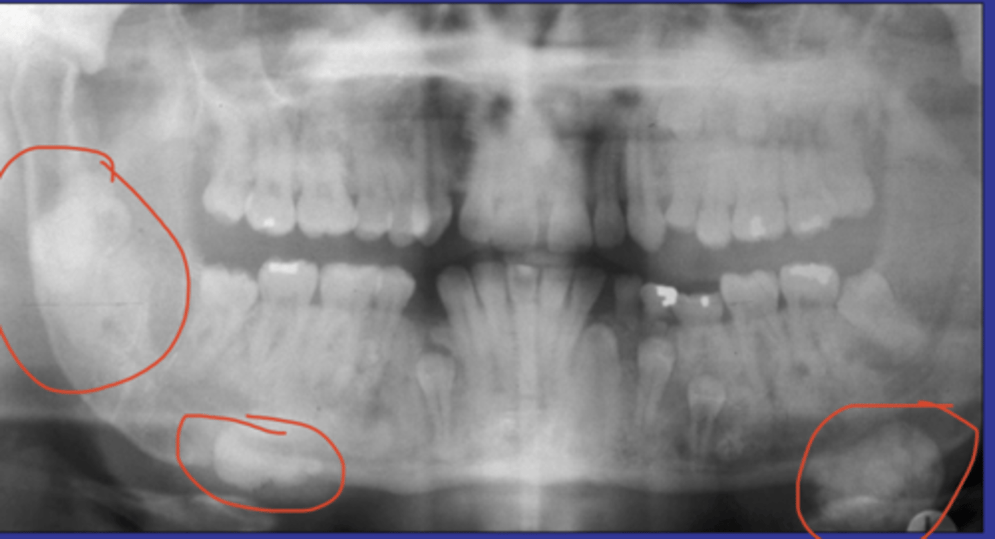 <p>it is a neoplasia; ass w/ gardners sx (multiple osteomas, intestinal polyps, supernumerary teeth)</p><p>common locations: mandible</p><p>radiographic: a well-defined radiopaque mass</p><p>population: YA</p>