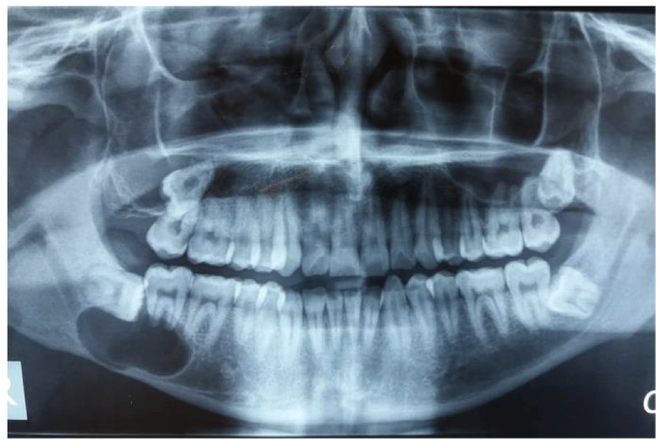 <p>A 25 year old patient present with mild swelling of lower jaw. Intra orally a small swelling was visible over right molar region. A radiograph taken. Provide diagnosis and justify</p>