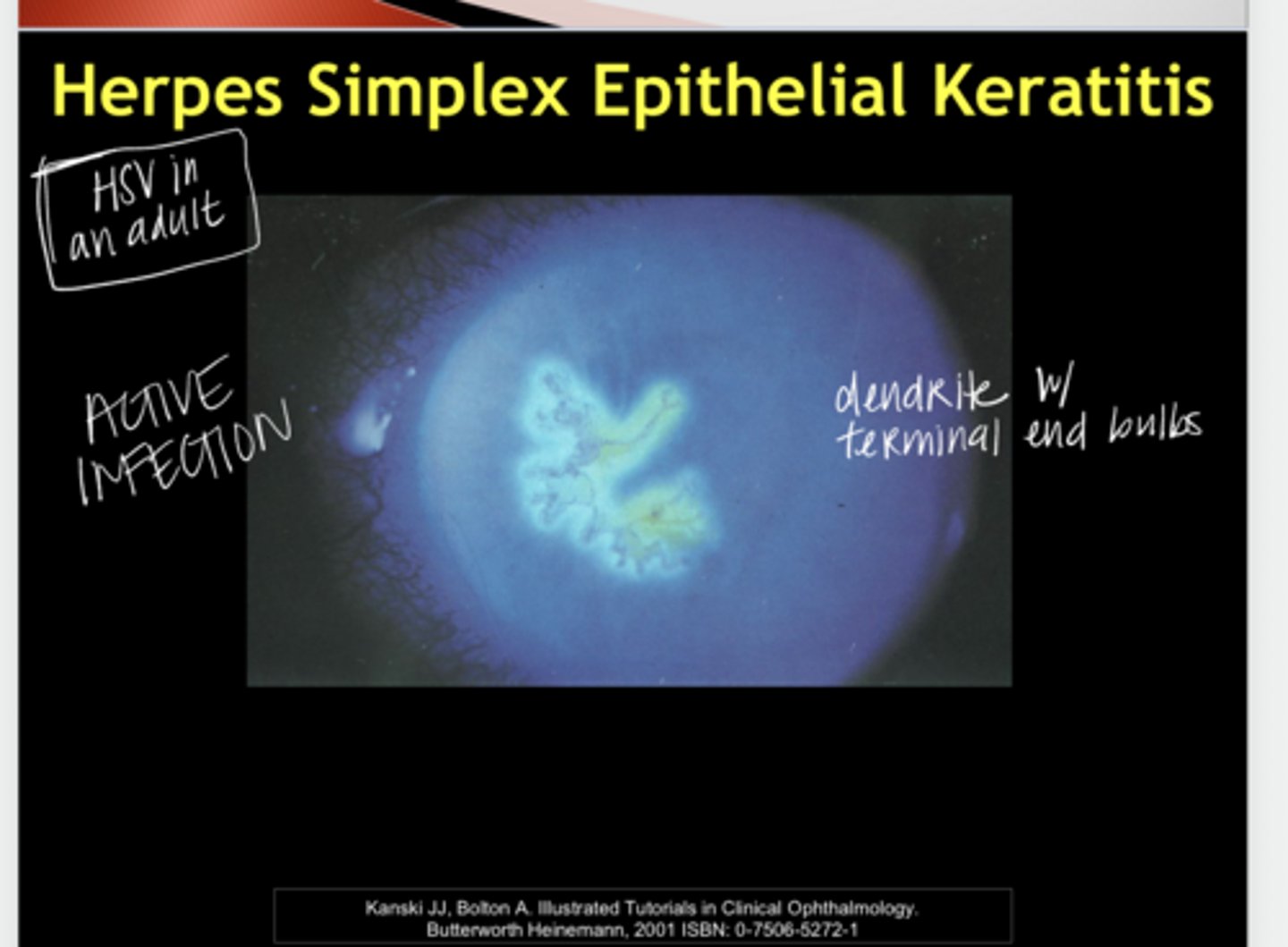 <p>Herpes Simplex Epithelial Keratitis (Pic)</p>