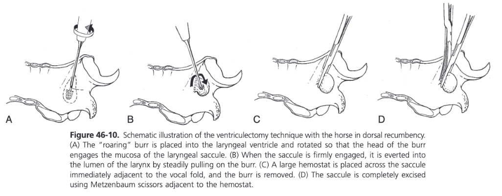 <ul><li><p><span>If it is performed under GA and after the laryngotomy has been completed, the endotracheal tube can be removed or left in place</span></p><ul><li><p><span>Use of a smaller endotracheal tube (&lt;20 FR) often negates the need for tube removal</span></p></li><li><p><span>A burr (e.g. Williams burr) is introduced into the ventricle to its maximum depth and twisted to engage the mucosa in the projections on the burr</span></p></li><li><p><span>Burr is subsequently withdrawn slowly from the ventricle, everting the attached saccule</span></p></li><li><p><span>A large forceps (Carmalt, curved Crile) is placed across the everted saccule between the head of the burr and the vocal fold</span></p></li><li><p><span>With traction on the clamp, a second forceps is placed behind it</span></p></li><li><p><span>By applying digital pressure on the opening of the ventricle, the entire saccule is everted and subsequently excised with Metzenbaum scissors</span></p></li><li><p><span>The same procedure is repeated on the other side if bilateral VC is indicated</span></p></li></ul></li></ul>